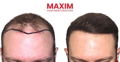 Maxim Hair Replacement Lounge